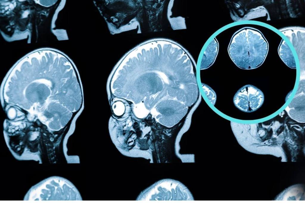 Cerebro de niño con leucodistrofia