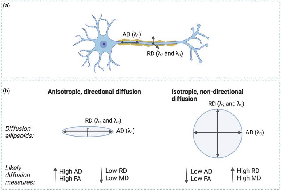 Figura 1.Medidas de imágenes del tensor de difusión (DTI) explicadas. (a) Visualización de medidas de DTI superpuestas en una fibra neuronal, que muestra difusión paralela (es decir, axial) versus perpendicular (es decir, radial) a lo largo de la longitud del axón. Los tractos de materia blanca están formados por haces de estas fibras axónicas. (b) Difusión anisotrópica/direccional versus difusión isotrópica/no direccional visualizadas como elipsoides de difusión, con probables medidas de difusión correspondientes. Los elipsoides de difusión se pueden utilizar para mostrar datos del tensor de difusión, donde el eje horizontal del elipsoide da la dirección de difusión primaria (es decir, coincidiendo con la dirección de las fibras axónicas) y la forma está determinada por el grado de anisotropía. Una anisotropía fraccional más alta y valores de difusión promedio más bajos pueden indicar difusión direccional de moléculas de agua, mientras que una anisotropía fraccional más baja y valores de difusión promedio más altos pueden indicar difusión no direccional de moléculas de agua. Es probable que existan niveles óptimos de difusión según la edad, como se explica con más detalle en el texto principal. Nota: Lambda 1-3 (λ 1 , λ 2 , λ 3 ) se refiere a valores propios que cuantifican la magnitud de la difusión del agua a lo largo de los tres ejes principales de un vóxel. Creado en BioRender. Townend, S. (2025) 