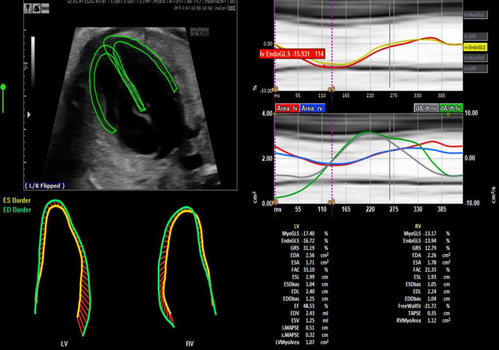 Figura 1. Interfaz del software TomTec. Izquierda: Vista de 4 cámaras que muestra los contornos del miocardio de ambos ventrículos monitoreados. Derecha: La salida de datos de cada ventrículo incluye indicadores de morfometría y función cardíaca, incluyendo la deformación (es decir, la tensión cardíaca).
