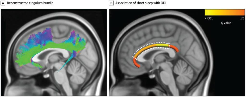 Figura 2. Hallazgos del haz cingulado. Las líneas blancas punteadas indican la región del haz cingulado con valores Q inferiores a 0,05. El fondo de ambos paneles es el cerebro estándar de 1 mm del Instituto Neurológico de Montreal 152.