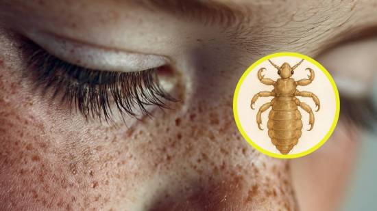Te contamos si existe la pediculosis fuera del cabelludo y qué diferencias hay