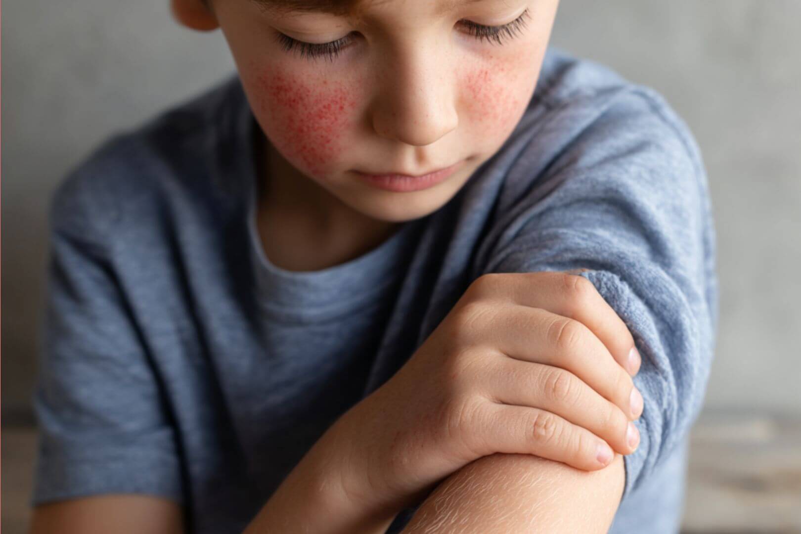 Niño con rojeces en la piel y rascándose el brazo debido al picor, posible reacción cutánea común en la infancia.